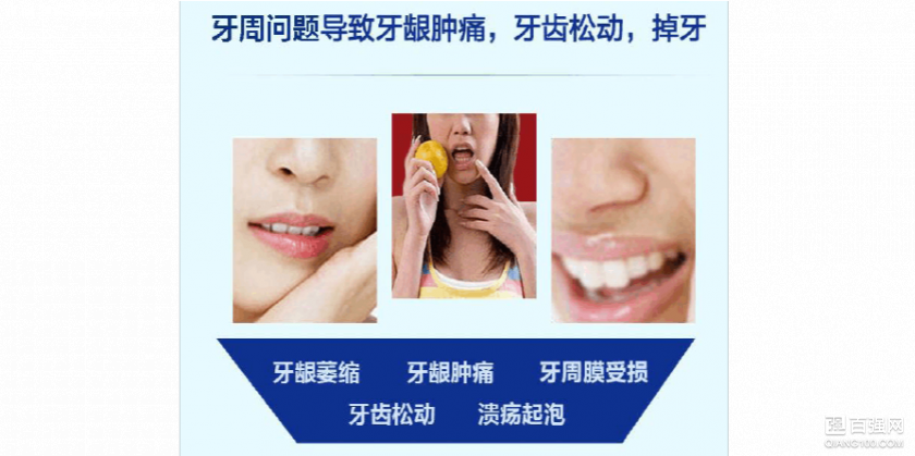 牙周炎的克星，你的牙周炎有救了