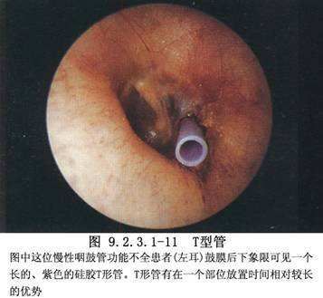 波氏球吹张能清除中耳积液吗 波氏球吹张能清除中耳积液吗