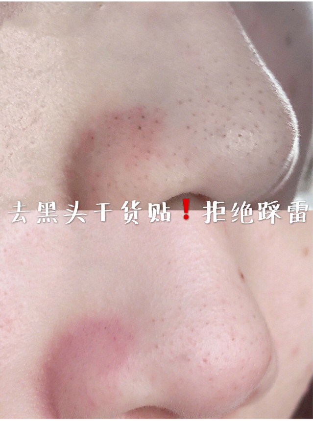 干货!苏诗雅黑头仪一周完美去黑头,解决草莓鼻! 干货!苏诗雅黑头仪一周完美去黑头,解决草莓鼻!