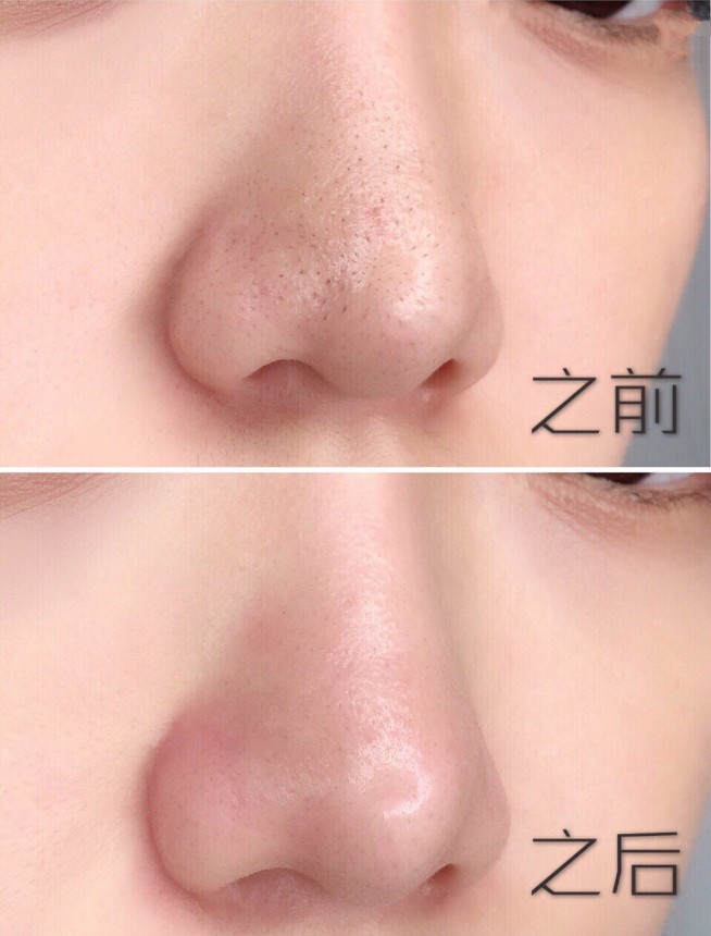 干货!苏诗雅黑头仪一周完美去黑头,解决草莓鼻! 干货!苏诗雅黑头仪一周完美去黑头,解决草莓鼻!