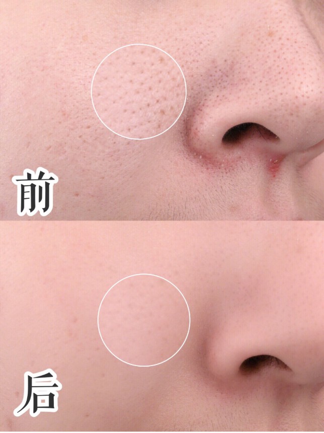 抗黑头经验分享，七年黑头终于拔除，用苏诗雅黑头仪，告别草莓鼻