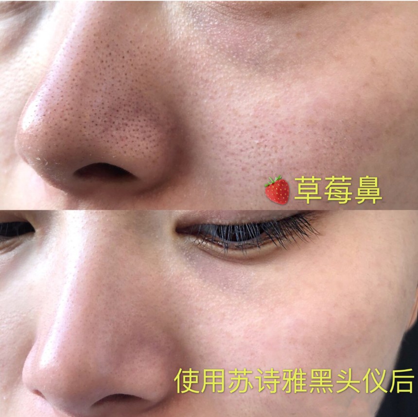 抗黑头经验分享，七年黑头终于拔除，用苏诗雅黑头仪，告别草莓鼻
