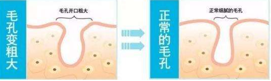 面部毛孔粗大如何解决？3大误区需谨慎
