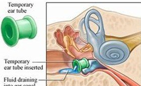耳朵嗡嗡响怎么办 以下方法可能对你有帮助 耳朵嗡嗡响怎么办 以下方法可能对你有帮助