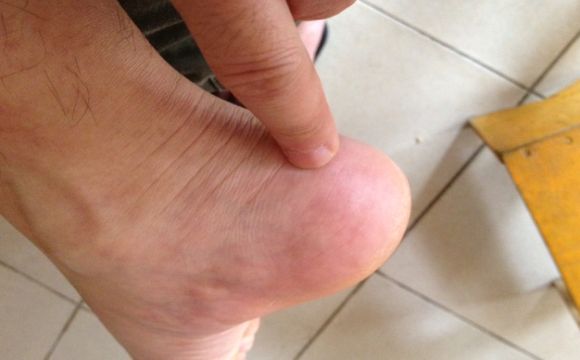 老年人脚后跟骨刺引起原因和治疗方法 老年人脚后跟骨刺引起原因和治疗方法