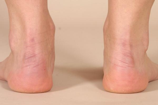 老年人脚后跟骨刺引起原因和治疗方法 老年人脚后跟骨刺引起原因和治疗方法