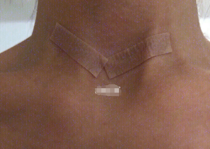 美皮护疤痕贴价格?多少规格的? 美皮护疤痕贴价格?多少规格的?