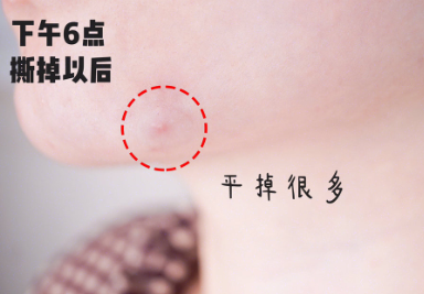 护妍天使痘痘贴好用吗?主要成分是什么呢? 护妍天使痘痘贴好用吗?主要成分是什么呢?