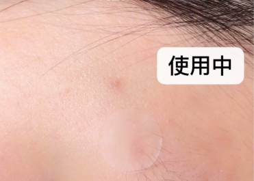 vt痘痘贴成分？可以使痘痘消肿吗？