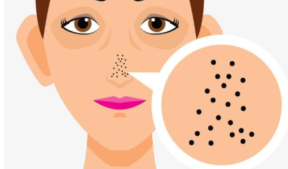 卸妆油可以去黑头吗 这篇小百科告诉你答案 卸妆油可以去黑头吗 这篇小百科告诉你答案