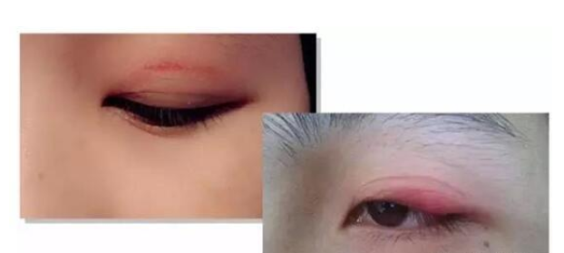 双眼皮贴贴久了有害吗 双眼皮贴的正确贴法 双眼皮贴贴久了有害吗 双眼皮贴的正确贴法