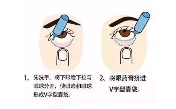 眼药水不能随便用?眼药水使用注意事项 眼药水不能随便用?眼药水使用注意事项