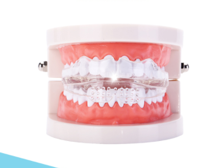 隐形牙套分类 隐形矫治知识分享 隐形牙套分类 隐形矫治知识分享