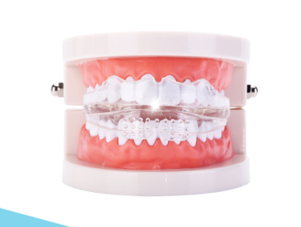 隐形牙套分类 隐形矫治知识分享 隐形牙套分类 隐形矫治知识分享