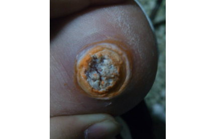 鸡眼贴怎么用正确?鸡眼贴到什么程度算好? 鸡眼贴怎么用正确?鸡眼贴到什么程度算好?