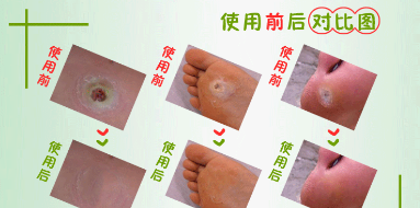 鸡眼贴怎么用正确?鸡眼贴到什么程度算好? 鸡眼贴怎么用正确?鸡眼贴到什么程度算好?