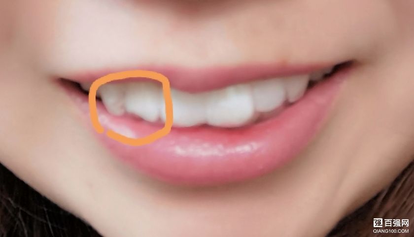 考虑再三,终于鼓起勇气来整牙了 考虑再三,终于鼓起勇气来整牙了