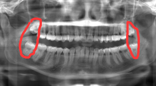 考虑再三,终于鼓起勇气来整牙了 考虑再三,终于鼓起勇气来整牙了